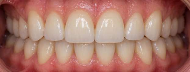 After full mouth reconstruction: restored function and aesthetics