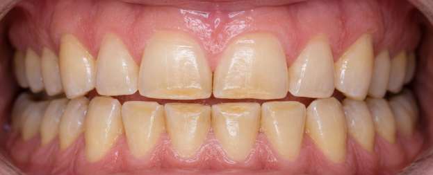 Before treatment: severe tooth wear with loss of tooth structure